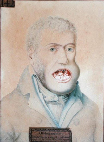 ギヨーム・デュピュイトレン（1777-1835）が手術を成功させた下顎の骨肉腫（紙に鉛筆） 作： School French
