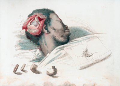 左下の破砕された骨片の穿刺と除去後の頭蓋骨の傷の図、1821 年 作： Thomas Landseer