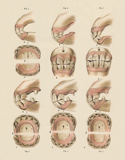 歯によって示される、年齢を示すプレートの説明、c1879。 作： Unbekannt