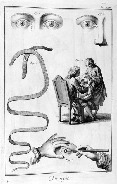 眼科手術、1751-1777 作： Unbekannt