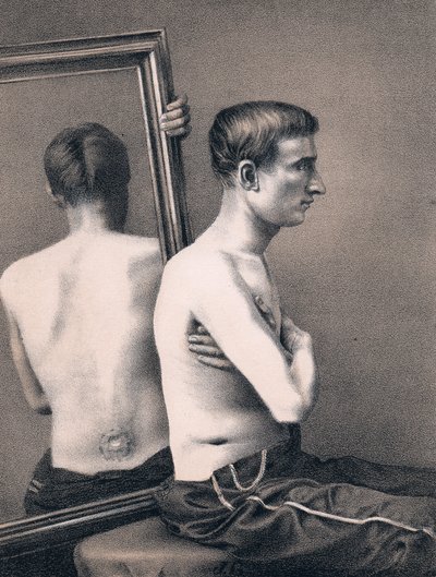 1865年の南北戦争、腹部への銃創の負傷者の回復 作： Unbekannt
