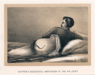 Shippens股関節で成功した切断術、南北戦争、1865年 作： Unbekannt