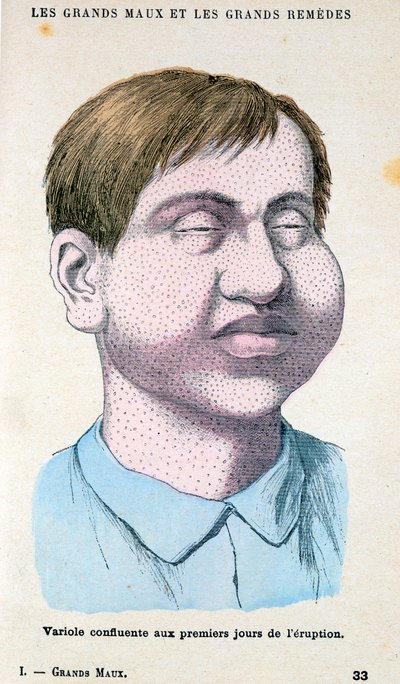 天然痘の犠牲者、c1890 作： Unbekannt