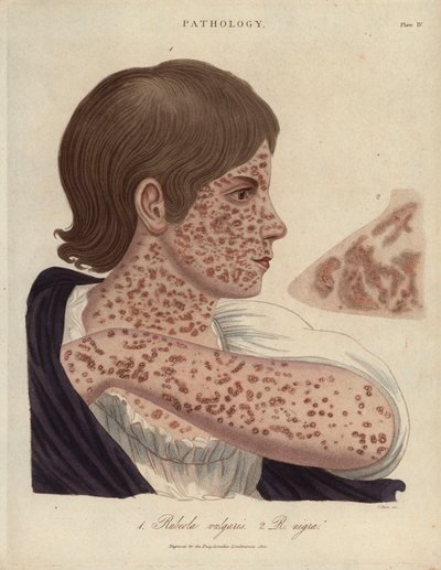麻疹とルベオール-ジョン・パスによる石版画、ジョン・ウィルクス著 "Encyclopedia Londinensis "に掲載、J.Adlard版、ロンドン 作： Unbekannter Künstler