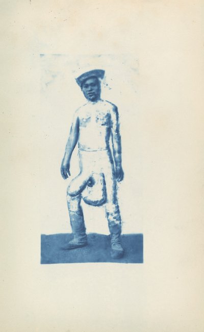 象皮病 作： Unknown 19th Century