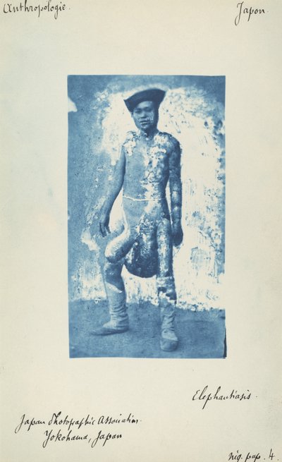 象皮症 作： Unknown 19th Century