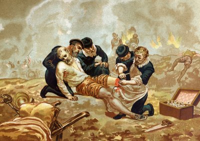アンブロワーズ・パレ医学者・フランス人外科医（1509年頃～1590年）が切断後の動脈の結紮を行う。1877年、バルセロナ。 作： Unknown artist