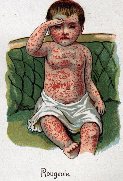 子供たちの病気はしか。F.E.Bilzの "The New Natural Medicine "に掲載されています。 作： Unknown artist