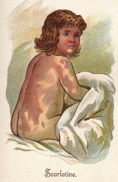 子供の病気。猩紅熱（しょうこうねつF.E.Bilzの "The new natural medication "に掲載されています。 作： Unknown artist