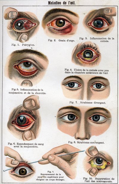 目の病気。"The new natural medicine" by F.E. Bilz. 作： Unknown artist