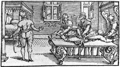 脱臼の整復（1560年頃、Ambroise Paréの「Traité Médical」より）。 作： Unknown artist
