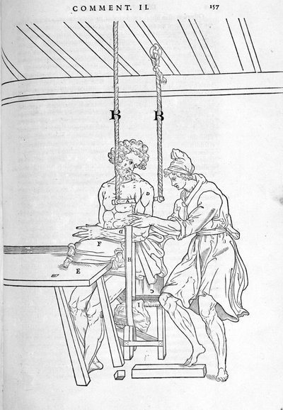 骨折の軽減。カルロ・ステファノ・リベリオ著「人間の体の部分的な解剖」（1545年、パリ）の図解版。「カルロ・ステファノ・リベリオ著、1545年パリ。 作： Unknown artist