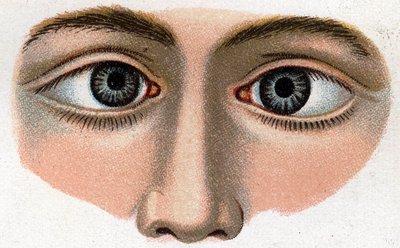 ストラビスムスの収束"The new natural medication" by F.E. Bilz. 作： Unknown artist