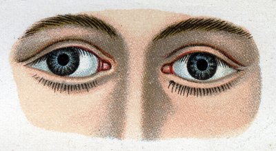 斜視の発散。"The new natural medication" by F.E. Bilz. 作： Unknown artist