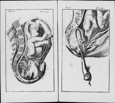 鉗子を使った出産 ウィリアム・スメリー（1697-1763）の「An abridgemaent of practise of midwifery」より引用 作： Unknown artist