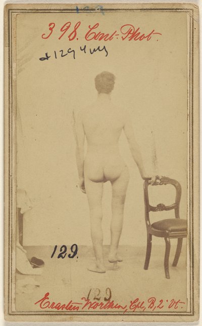 大腿骨上部3分の1の骨折。エラスタス・ウォーセン、Co.B. 2nd Vermont Vols、25歳-Stockbridge VT在住。 作： Unknown artist