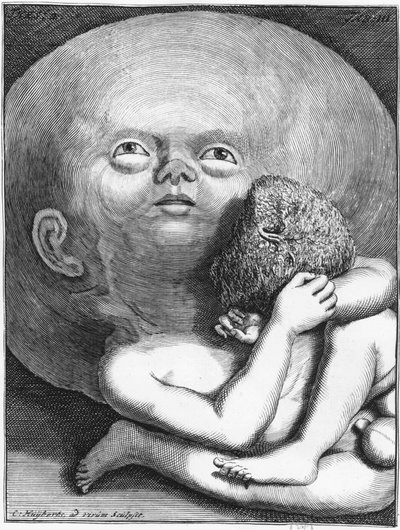 モンスター。子供の水頭症の人間学-グラヴ、n.d.、18世紀後半 作： Unknown artist