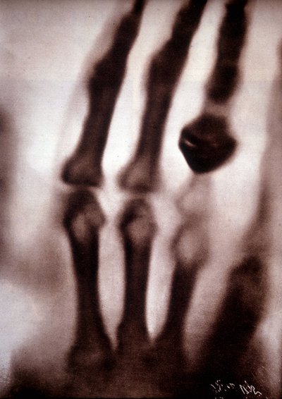 レントゲン線（Rontgen）またはX線 最初の写真：レントゲンの妻の手。22/12/1895. 作： Unknown artist