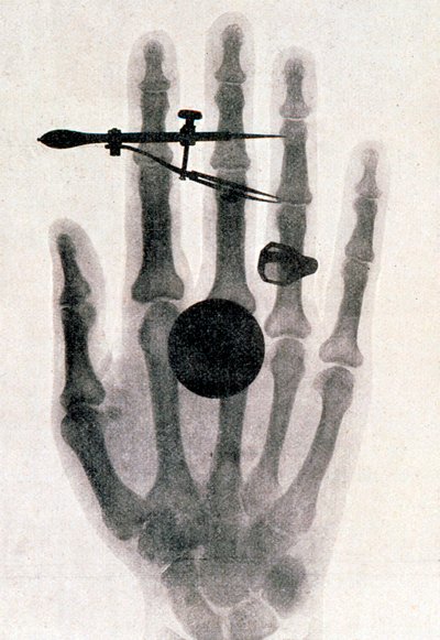 ウィルヘルム・レントゲンが妻の手を撮影したX線写真（1896年 作： Wilhelm Conrad Rontgen