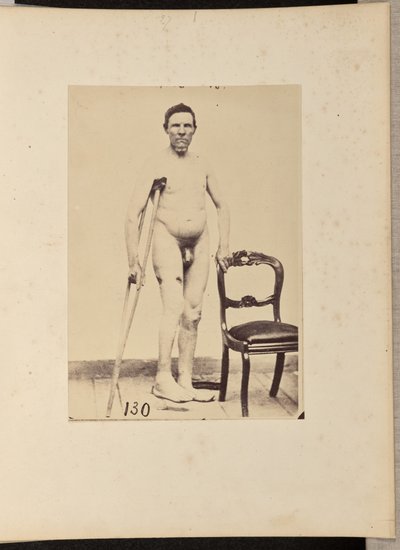 右大腿骨中3分の1の統合銃創 作： William H. Bell