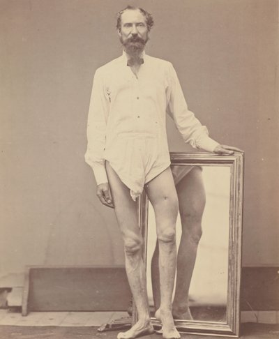 左大腿部中3分の1を銃で撃たれた傷（1865-67年）。 作： William H. Bell