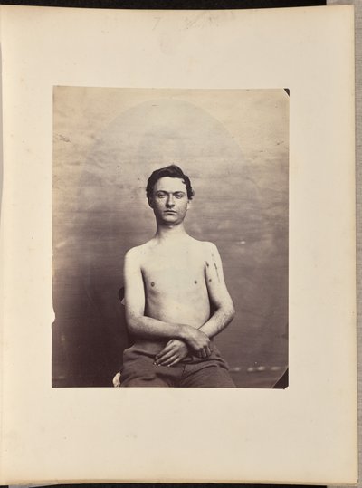 銃創による左上腕骨骨頭切除後の回復について 作： William H. Bell
