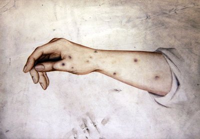 皮膚病の前腕部の習作 1850年頃 （紙に水彩画） 作： William Lover