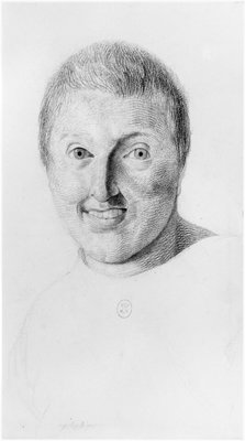 てんかん女性 正面図 サルペトリ