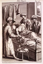 1745年のプロスペロアルピニによる医学エジプト人の灸のイラスト
