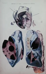 パリで出版されたJean Cruveilhier (1791-1874)の「Anatomie pathologique du corps humain」の図版で、心臓と肺の発作。