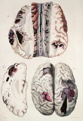 毛細血管性脳卒中、ジャン・クルヴェイリエ（1791-1874）1828-42年の「人間の病理解剖」より（彩色済み版画）