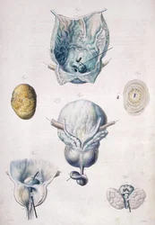 膀胱と前立腺の疾患、Jean Cruveilhier（1791-1874）の「Anatomie Pathologique du Corps Humain」より 1828-42年（彩色された彫刻）。