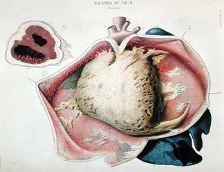 パリで出版されたJean Cruveilhier（1791-1874）の「Anatomie pathologique du corps humain」に掲載された心臓病を描いたプレート「心膜炎