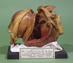 左心室の腫瘍のモデル、1799（ワックス）