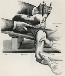 肩の切除（Louis-Hubert Farabeufの「Précis de Manuel Opératoire」より