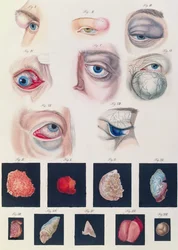 フリードリッヒ・アウグスト・フォン・アンモン（1799-1861）1838による、先天性の眼の異常の説明、病気の臨床的表現および人間の目の盲目な欠陥から