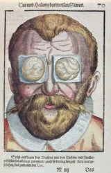 眼の状態の治療、1583年にドレスデンで出版されたGeorg Bartisch（1535-1636）によるOphthalmodouleiaから（カラー木版画）