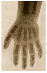 子供の手のX線c.1890