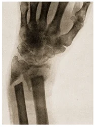 骨折した手首のX線c.1890