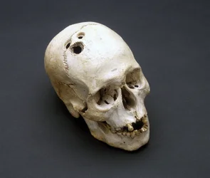 トレフィネーション 青銅器時代の頭蓋骨 パレスチナ、ジェリコ 紀元前2200～2000年