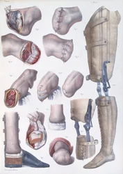 切断および補綴、ジャン・バティスト・マルク・ブールジェリー（1797-1849）1866-67による「Traite Complet de l&39;Anatomie de l&39;Homme」のプレート