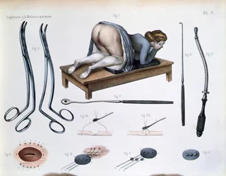 膀胱膣瘻の手術、Jean-Baptiste Marc Bourgery (1797-1849) 1866-67年の「Traite Complet de l