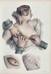 Jean-Baptiste Marc Bourgery（1797-1849）1866-67による &39;Traite Complet de l&39;Anatomie de l&39;Homme&39;からの癌性腫瘍の手術