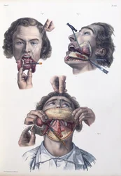 下顎の手術、ジャン・バティストマルクブールジェリー（1797〜1849）、1866〜67年の「Traite Complet de l&39;Anatomie de l&39;Homme」のプレート
