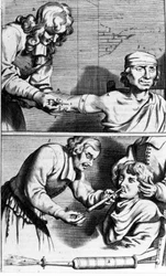 ヨハネス・スカルプテティ作「Armamentarium Surgery」アムステルダム1672年 出血と鼻腔シャワー