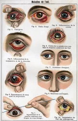 目の病気。"The new natural medicine" by F.E. Bilz.